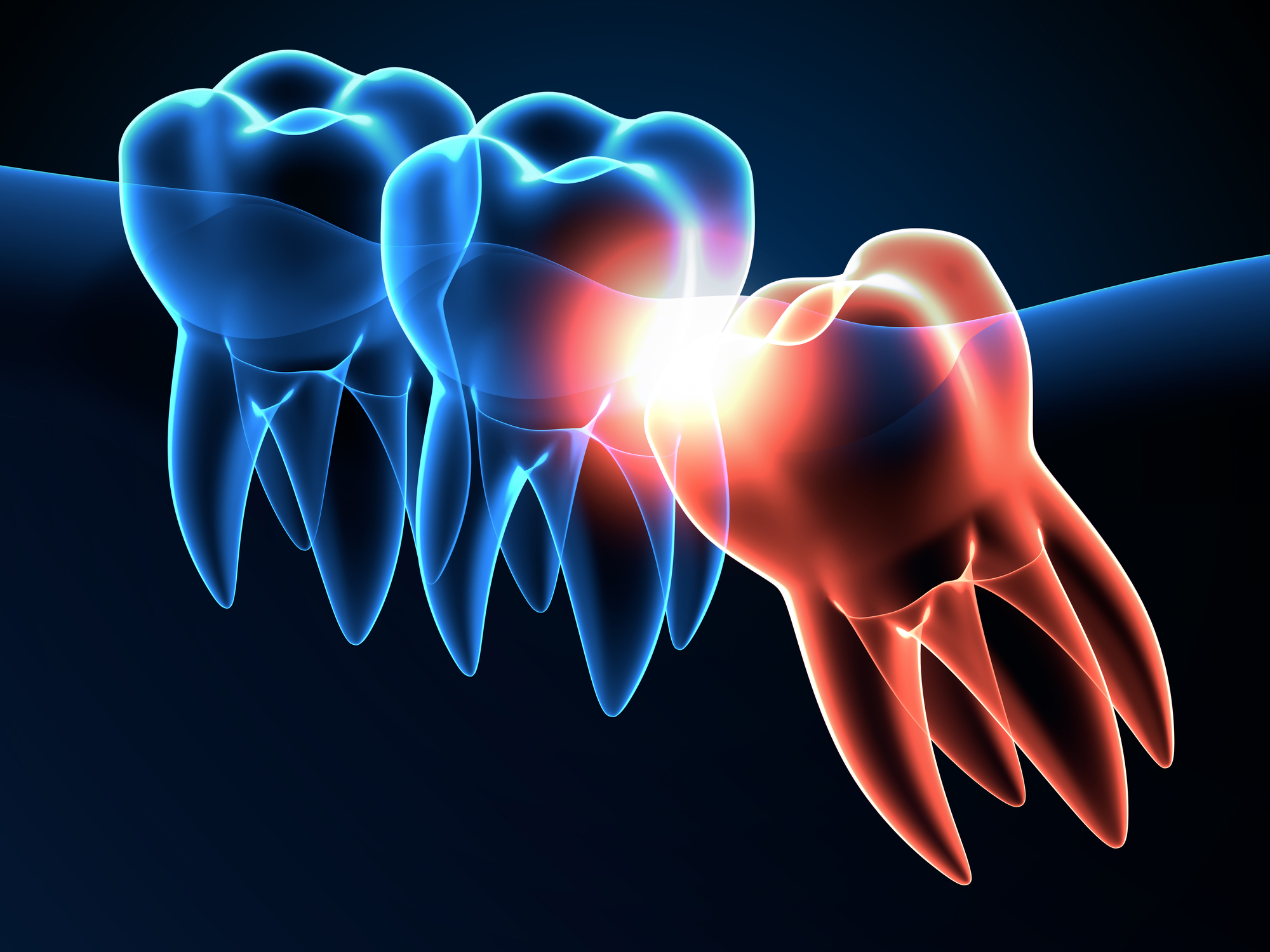 Can Wisdom Teeth Cause Migraines Find Neurologists Near Me